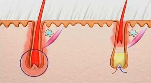 Il calore emesso dalla luce pulsata distrugge il bulbo che nutre il